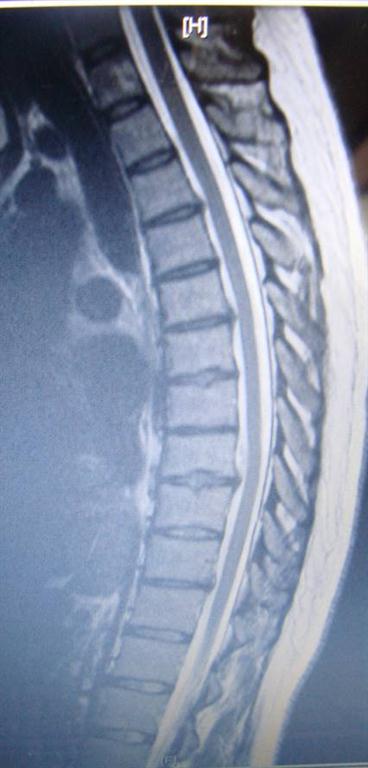 thoracic disc herniation treated by La Grande chiropractor